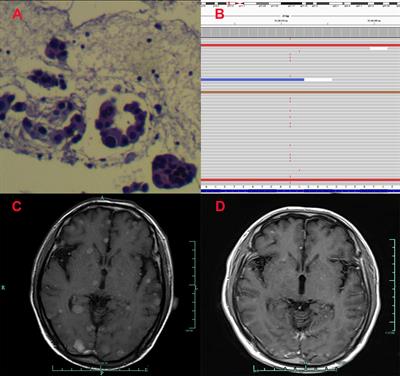 Double-dose icotinib may induce the emergence of the EGFR exon 20 T790M mutation in non-small cell lung cancer patients harboring EGFR-sensitive mutation